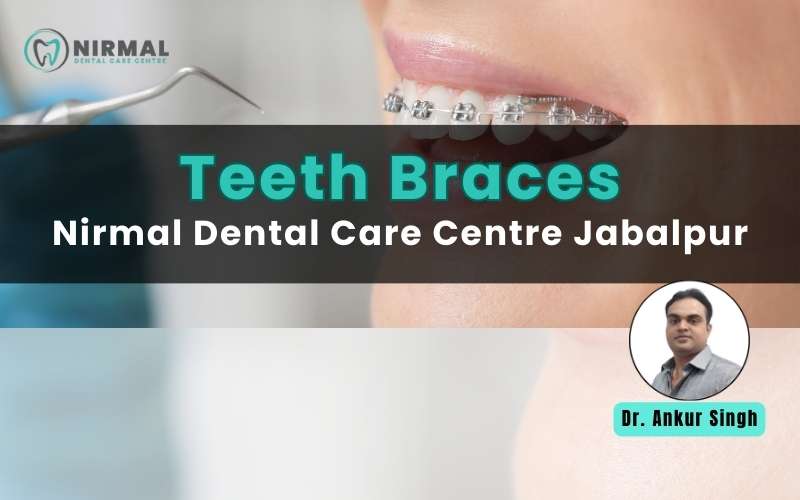 Teeth Braces Treatment at Nirmal Dental Care Centre Jabalpur