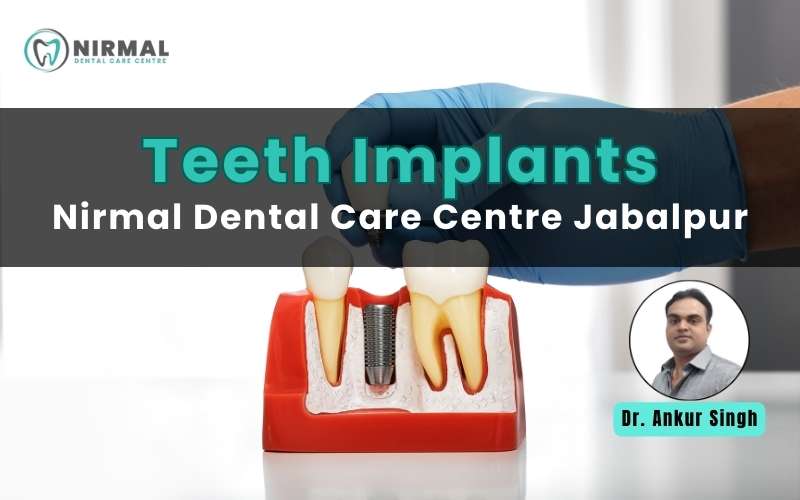 Teeth Implants Jabalpur at Nirmal Dental Care Centre by Dr. Ankur