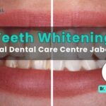 Teeth Whitening Treatment at Nirmal Dental Care Centre Jabalpur